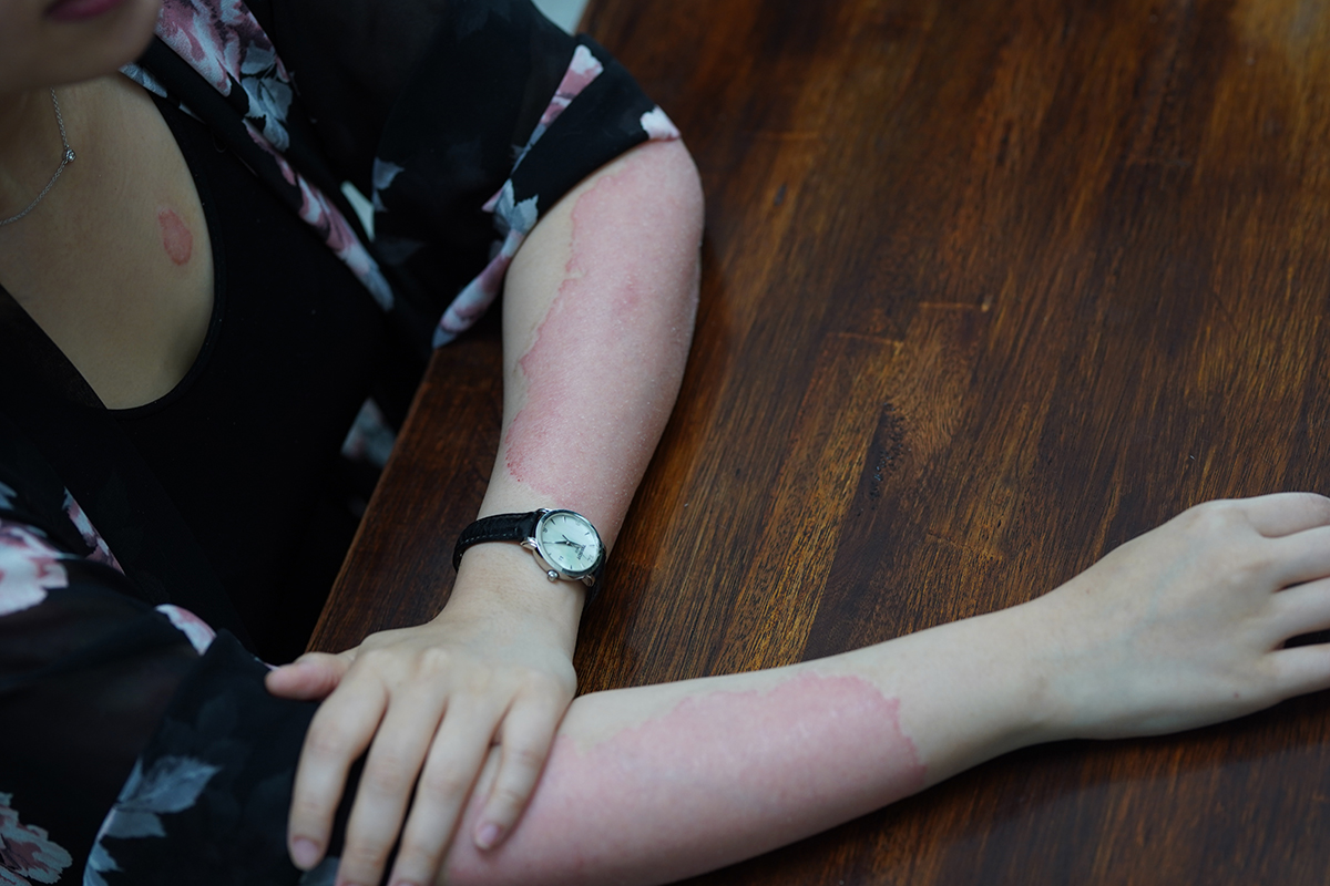 Rojak Daily/Afiqah Azizan It is more than just a skin condition.